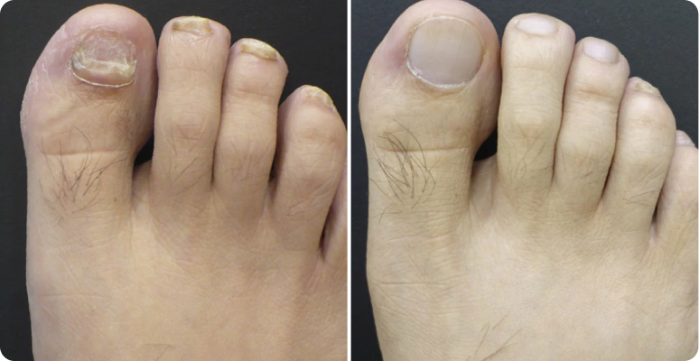 Ingrid Weber before after